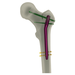 Intramedullary Rods