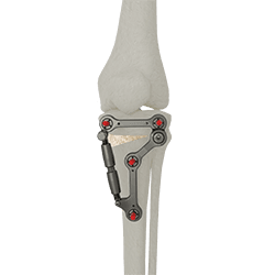 UniX® Metaphyseal Hinge Fixator
