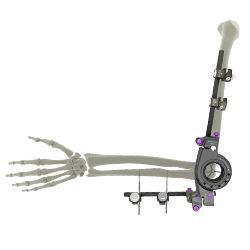 UniX® PDF Elbow Fixator