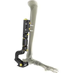 UniX® Standard & Hybrid Fixator