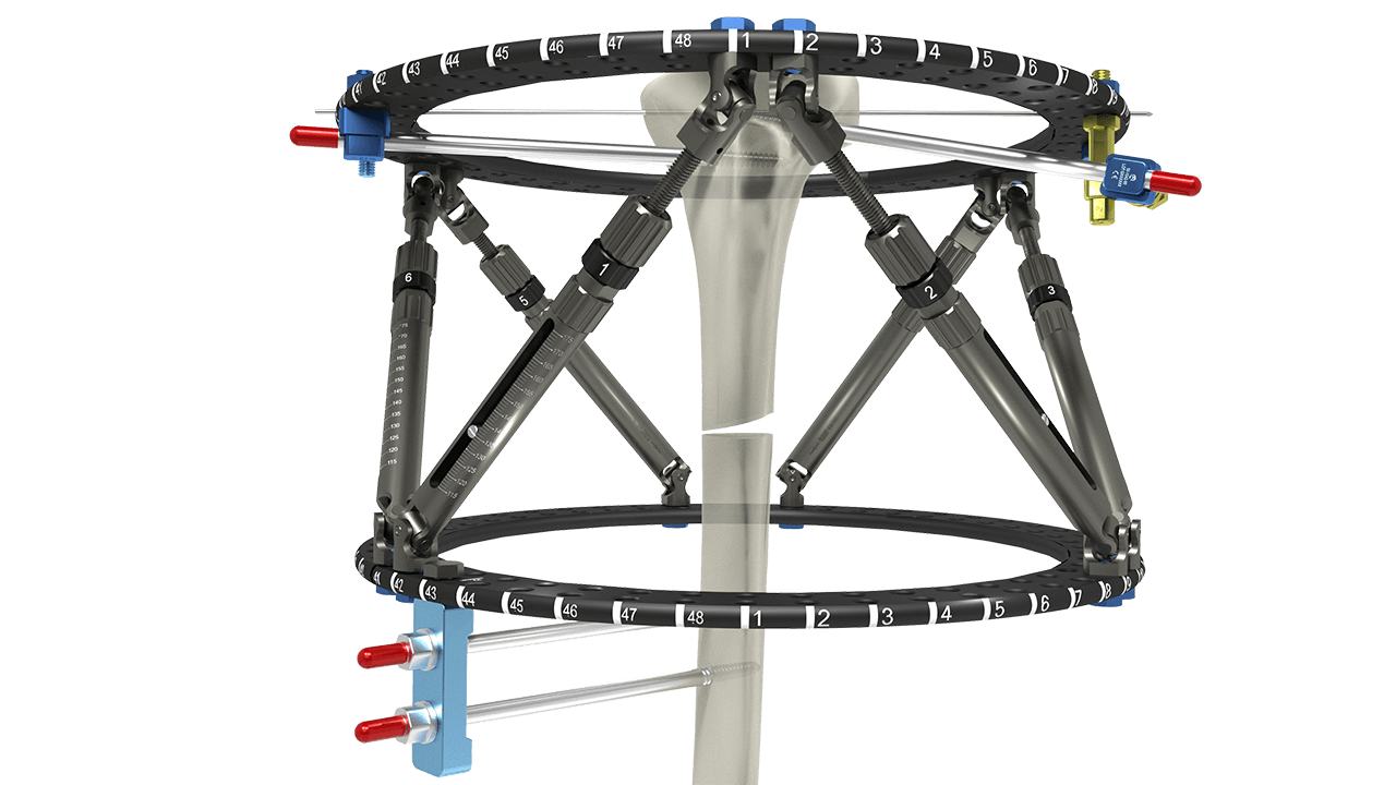 Smart Fixator®