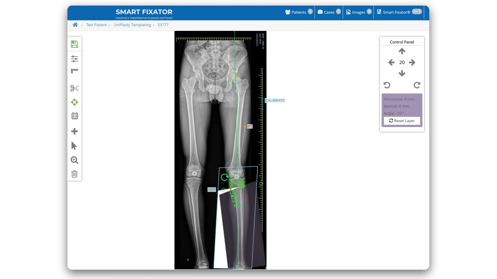 Smart Fixator planning screen: UniPlasty® high tibial osteotomy planned on a long-leg X-ray, distal tibia angulated