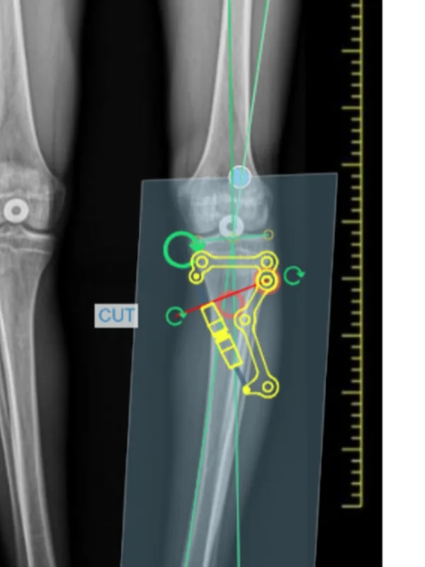 Step 4, Add the template: Add UniPlasty® - HTO, choose the side and the size (S, M or L) and place it on the proximal tibia.