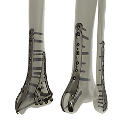 STEP Ankle Fracture Plating System