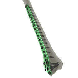 Distal Tibia Locking Plate