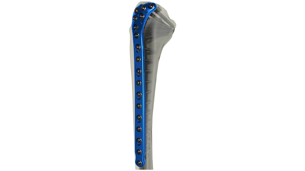 Proximal Tibia Locking Plate — view 1