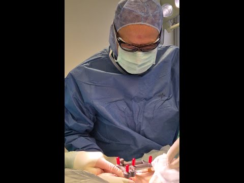 UniX® Metaphyseal Hinge Fixator Surgery by Prof. Rainer Baumgart