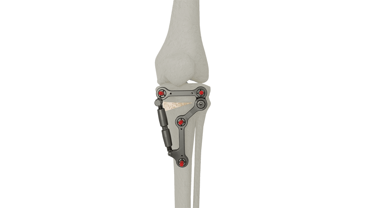 UniX® Metaphyseal Hinge Fixator — view 1