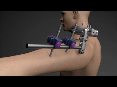 UniX™ PDF Elbow Fixator