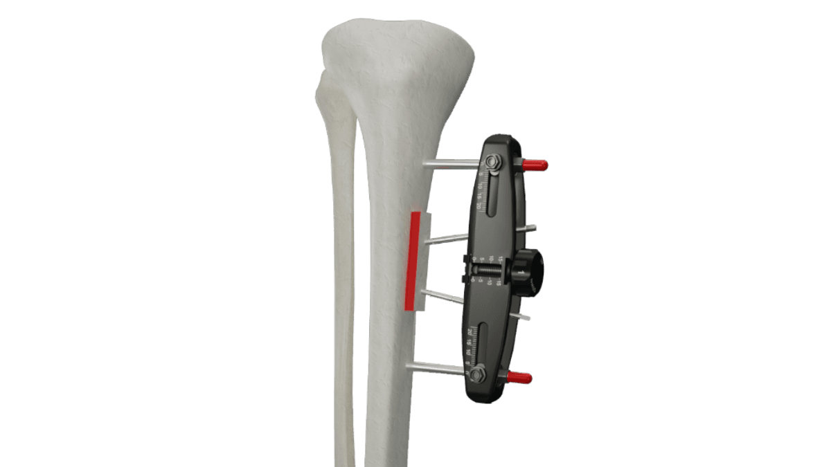 MicroLift® — view 1