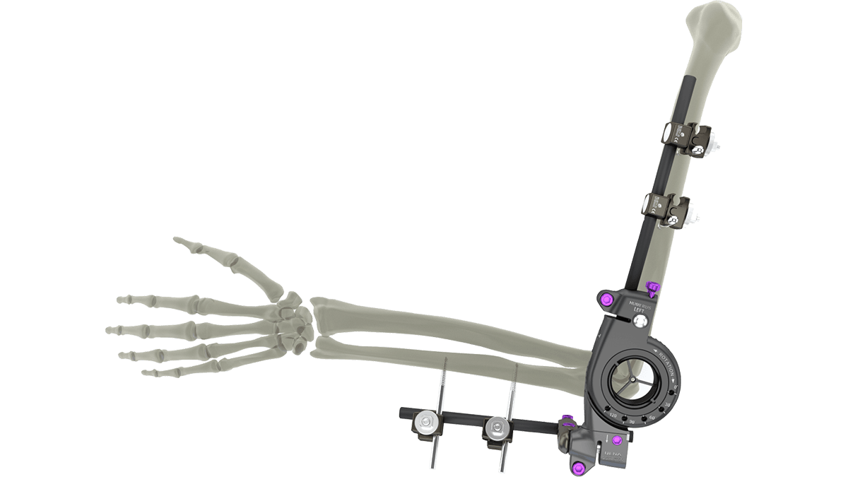 UniX® PDF Elbow Fixator — view 1