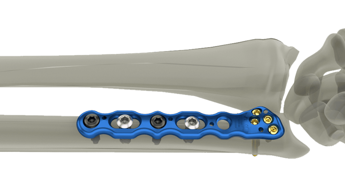 Wrist Plating System — view 1