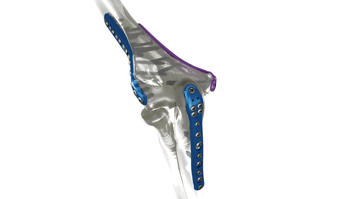 Anatomic Elbow Plates — view 1