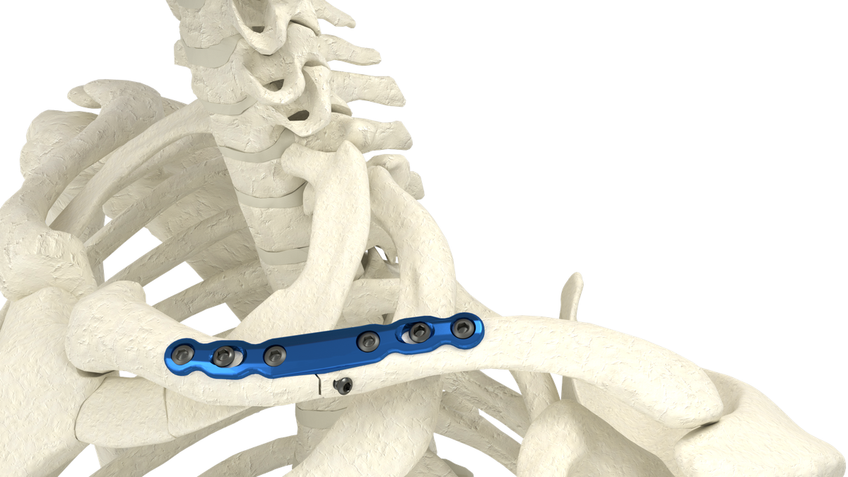 Clavicle Plating System — view 1