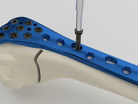 CompressNLock, Fracture compression with Locking Screw