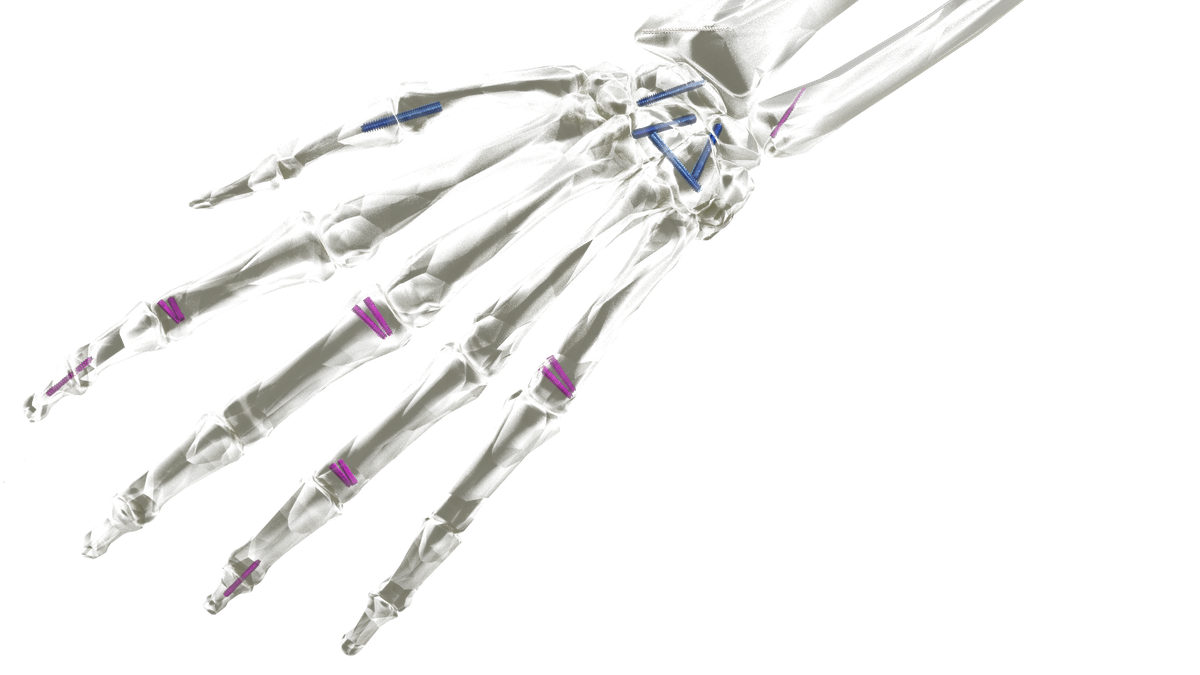Headless Compression Screw System — view 1